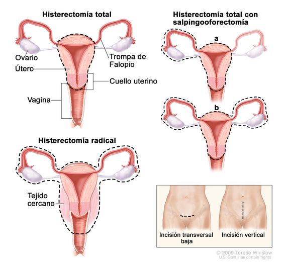 baja laboral por laparoscopia ovario