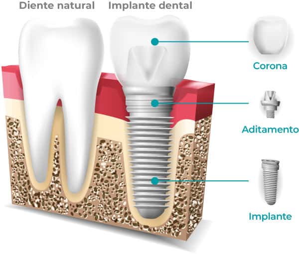 permiso laboral por implante dental