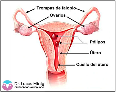 polipo endometrial baja laboral