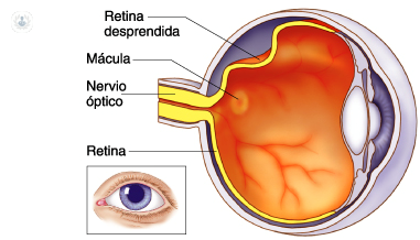 tiempo de baja por desprendimiento de retina